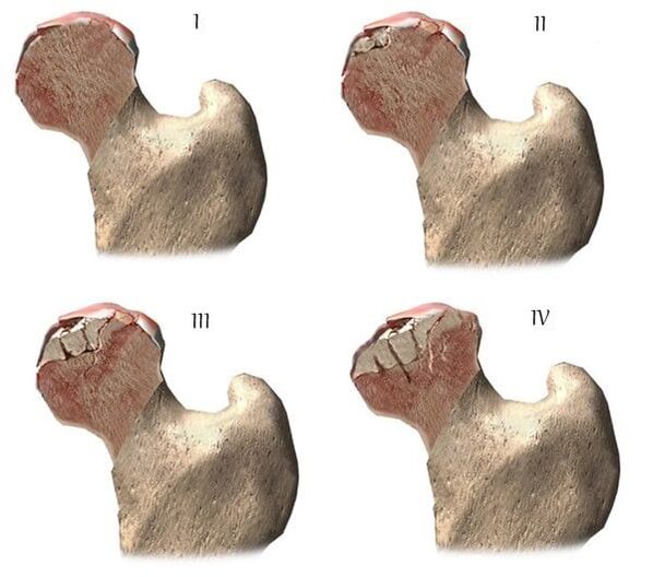 stages of hip arthrosis