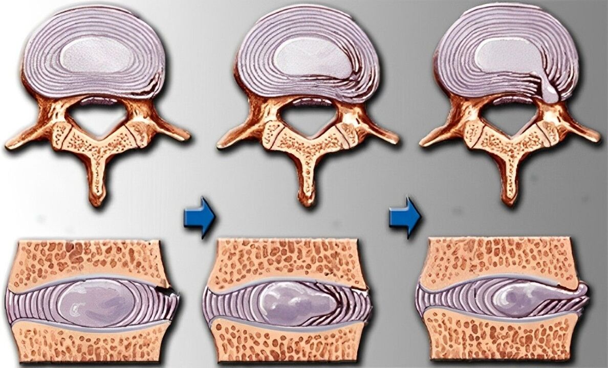 stage of osteochondrosis