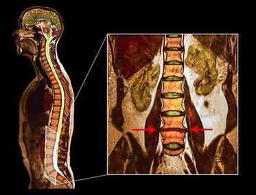 Degenerative disk in spine