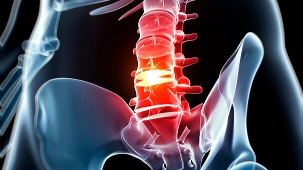 Osteochondrosis of lumbar spine