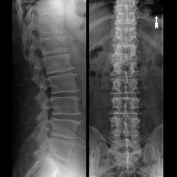 osteochondrosis of the spine region on X-ray