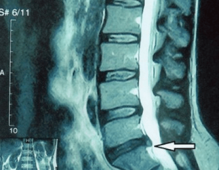 spinal disc protrusion on MRI scan