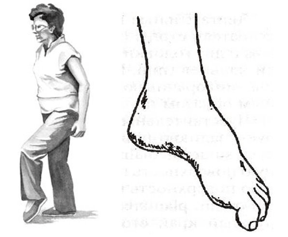 step or penile gait for osteochondrosis