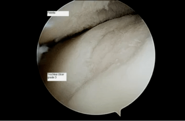 astroscopic view of the knee joint with arthrosis of the 3rd degree