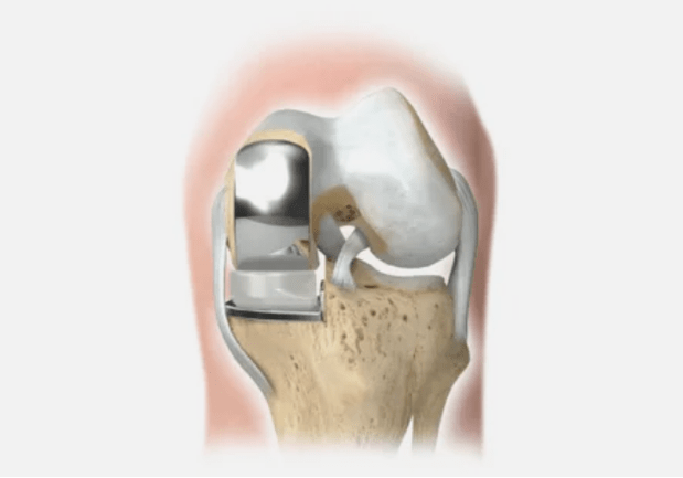 one part of the joint is damaged